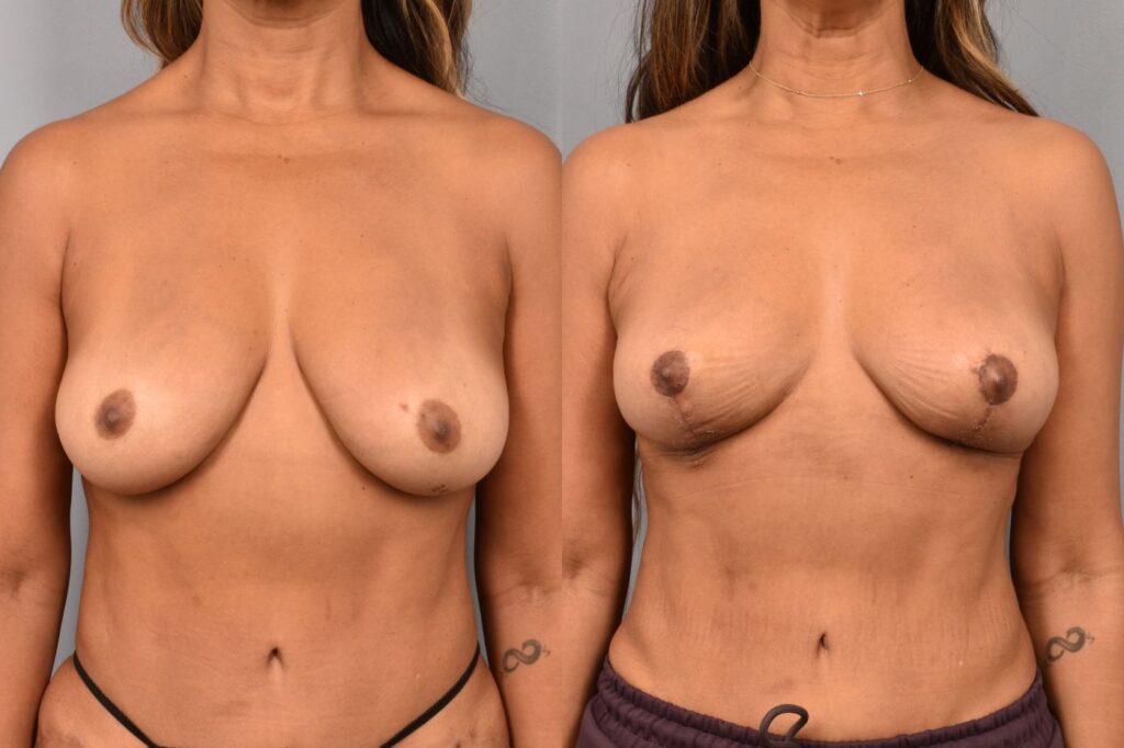 Side-by-side comparison of a female patient's straight-on view before and after breast lift by Dr. Bassiri-Tehrani. The left image shows her breast prior to surgery; the right image shows the same angle post-procedure