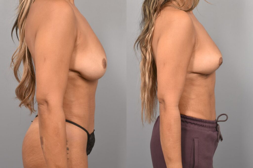 Side-by-side comparison of a female patient's right profile before and after breast lift by Dr. Bassiri-Tehrani. The left image shows her breast prior to surgery; the right image shows the same angle post-procedure