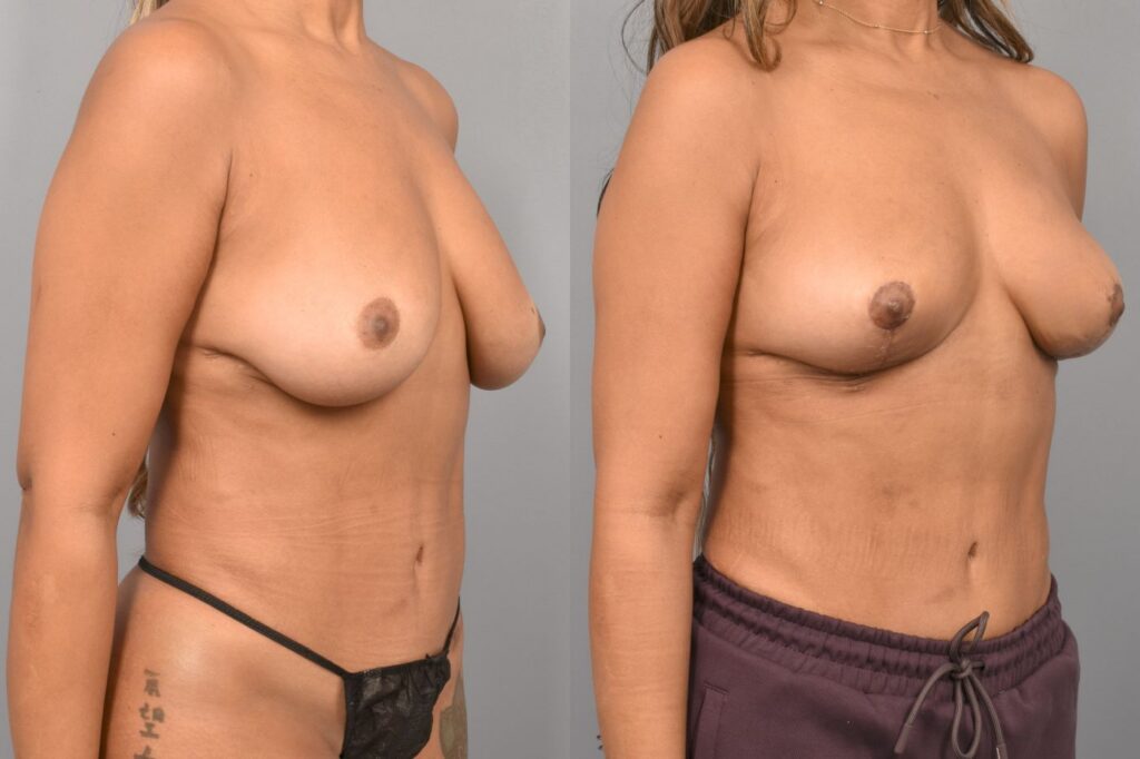 Side-by-side comparison of a female patient's right 3/4 view before and after breast lift by Dr. Bassiri-Tehrani. The left image shows her breast prior to surgery; the right image shows the same angle post-procedure
