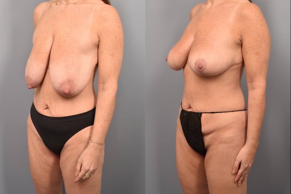 Side-by-side comparison of a female patient's left 3/4 view before and after breast lift by Dr. Bassiri-Tehrani. The left image shows her breast prior to surgery; the right image shows the same angle post-procedure
