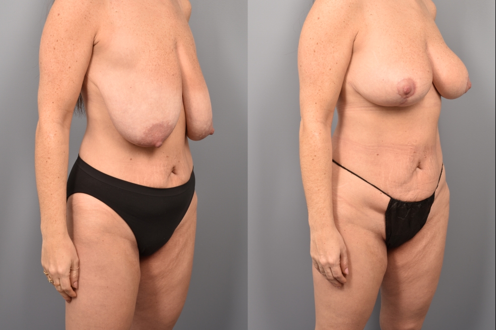 Side-by-side comparison of a female patient's right 3/4 view before and after breast lift by Dr. Bassiri-Tehrani. The left image shows her breast prior to surgery; the right image shows the same angle post-procedure