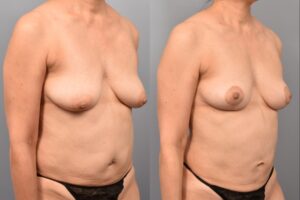Side-by-side comparison of a female patient's right 3/4 view before and after breast lift by Dr. Bassiri-Tehrani. The left image shows her breast prior to surgery; the right image shows the same angle post-procedure