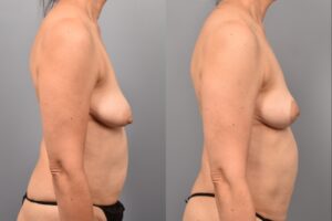Side-by-side comparison of a female patient's right profile before and after breast lift by Dr. Bassiri-Tehrani. The left image shows her breast prior to surgery; the right image shows the same angle post-procedure