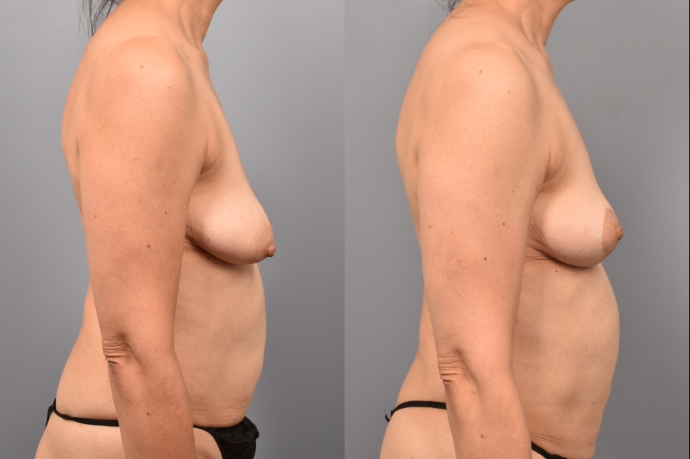 Side-by-side comparison of a female patient's right profile before and after breast lift by Dr. Bassiri-Tehrani. The left image shows her breast prior to surgery; the right image shows the same angle post-procedure