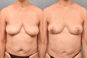 Side-by-side comparison of a female patient's straight-on view before and after breast lift by Dr. Bassiri-Tehrani. The left image shows her breast prior to surgery; the right image shows the same angle post-procedure