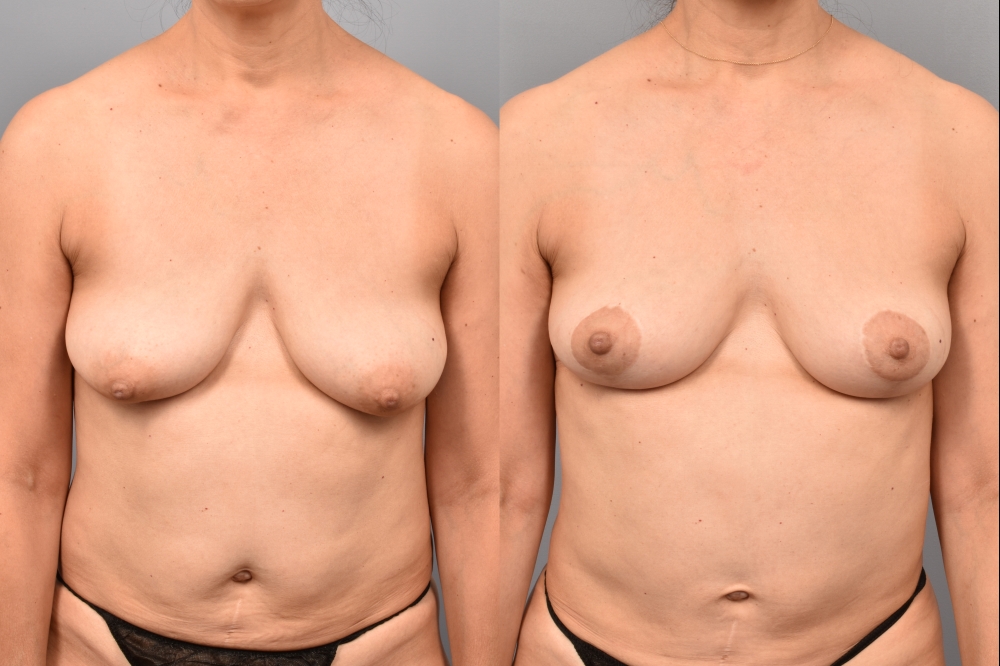 Side-by-side comparison of a female patient's straight-on view before and after breast lift by Dr. Bassiri-Tehrani. The left image shows her breast prior to surgery; the right image shows the same angle post-procedure