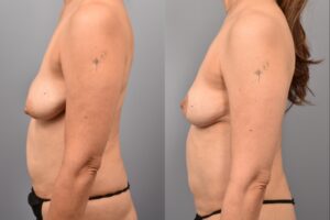 Side-by-side comparison of a female patient's left profile before and after breast lift by Dr. Bassiri-Tehrani. The left image shows her breast prior to surgery; the right image shows the same angle post-procedure